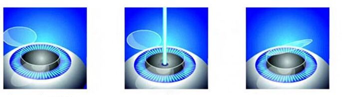 Stages of laser vision correction