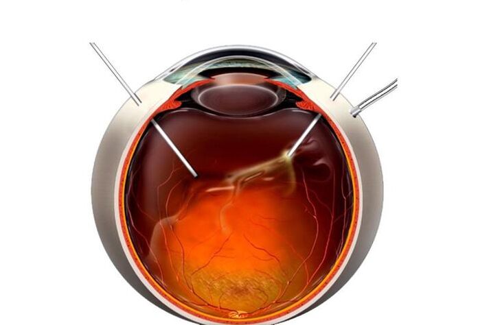 Vitrectomy - an operation to restore vision